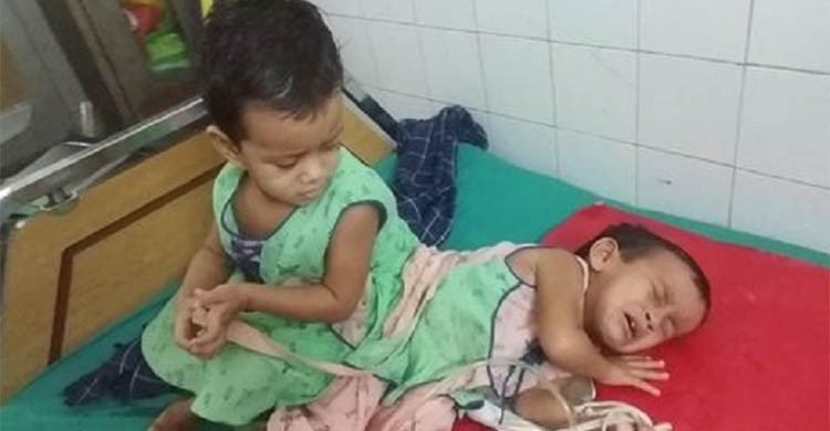 ঢামেকে জোড়া শিশুর অস্ত্রোপচার শুরু ঢামেকে জোড়া শিশুর অস্ত্রোপচার শুরু