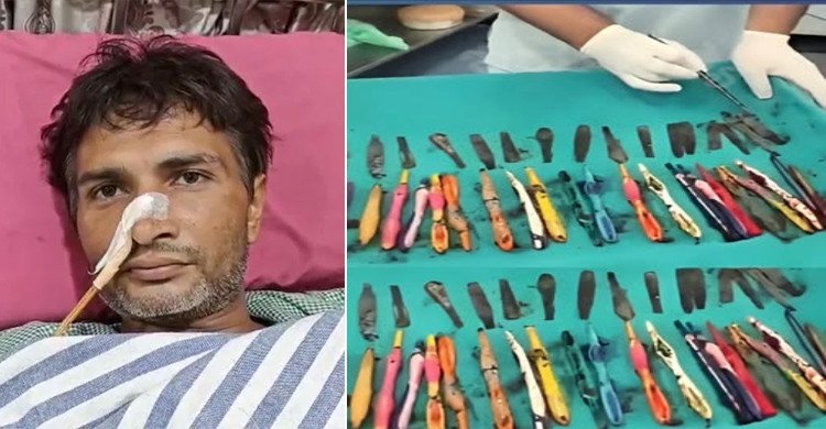 এক ব্যক্তির পেট থেকে বের হলো ২৯ চামচ, ১৯ টুথব্রাশ আর ২টি কলম