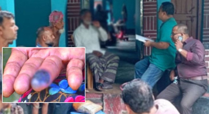 রংপুরের কাউনিয়ায় আরও দুইজন অ্যানথ্রাক্সে আক্রান্ত রোগী শনাক্ত