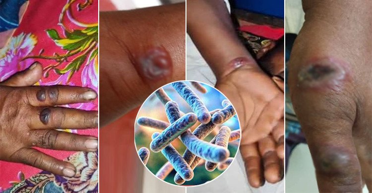 গাইবান্ধায় রোগাক্রান্ত গরু কাটাকাটির পর ‘অ্যানথ্রাক্সে’ আক্রান্ত ১১ জন