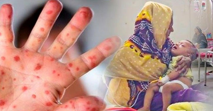 গত ২৪ ঘণ্টায় হাম উপসর্গে আরও ৮ মৃত্যু, প্রাণহানি ছাড়াল ৯০০