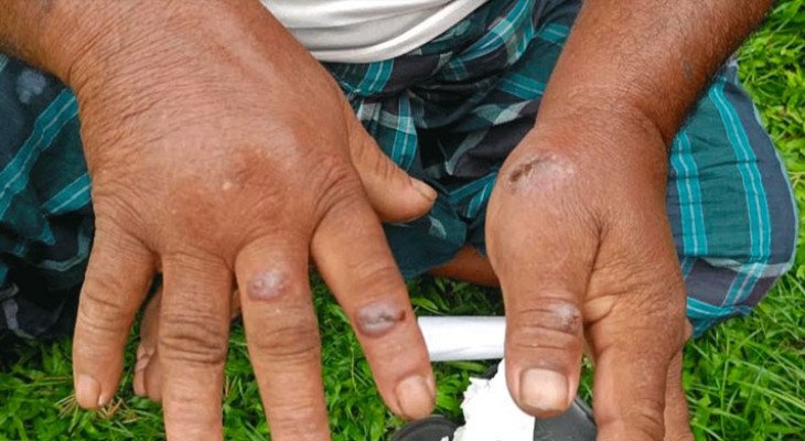 গাইবান্ধায় অ্যানথ্রাক্সে আক্রান্ত বেড়ে ৩৪, ১৯ হাজার গবাদিপশুকে টিকা