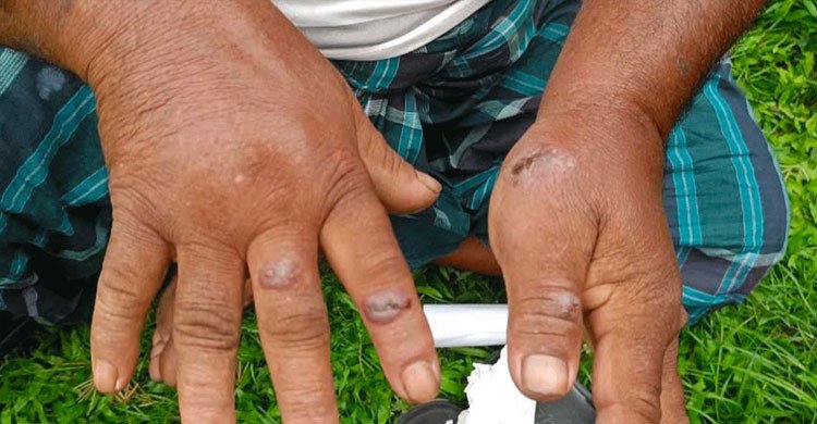 গাইবান্ধায় অ্যানথ্রাক্সে আক্রান্ত বেড়ে ৩৪, ১৯ হাজার গবাদিপশুকে টিকা