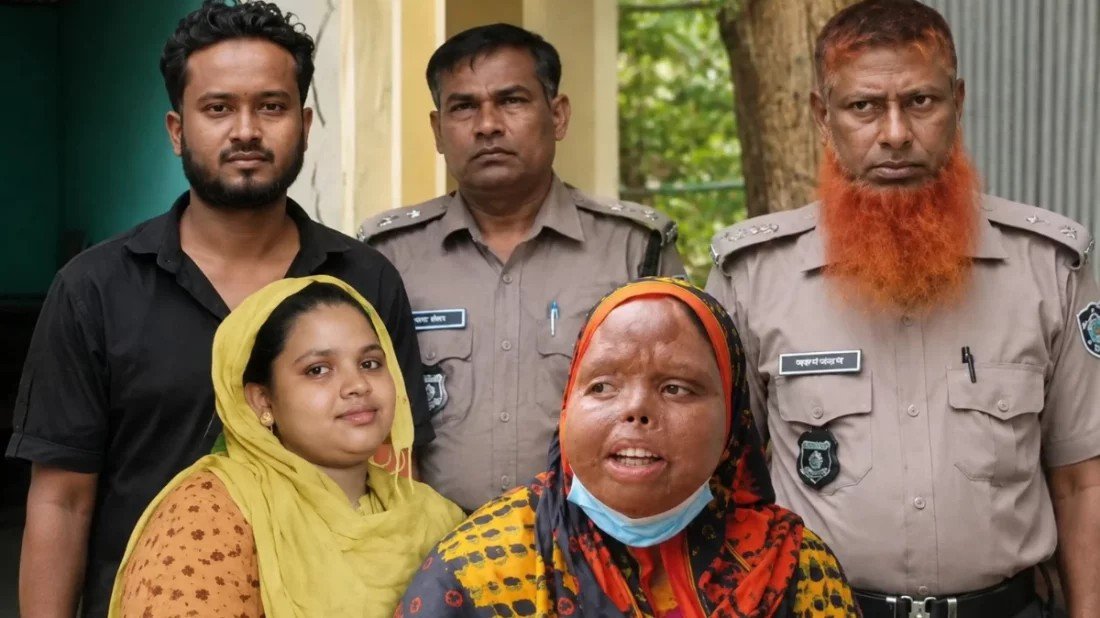 গরম ডাল ছুড়ে স্ত্রীর মুখ ঝলসানোর পর তালাক, মামলায় কারাগারে স্বামী